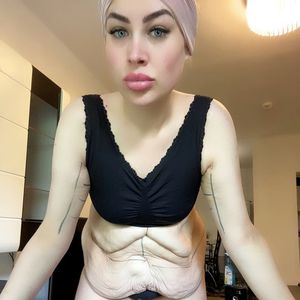 Aline Bachmann hat ein Ziel: Erst OP-Marathon – dann GNTM!