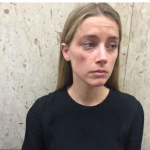 Amber Heard zeigt Prügelfotos: Warf Johnny Handy nach ihr?