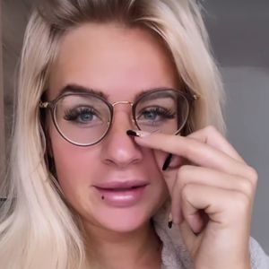 Blau und dick: "Love Island"-Anna hat sich Nase verstaucht