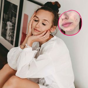 Ehrliche Fotos: Model Anna Wilken hatte früher starke Akne