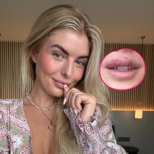 Antonia Hemmer hat nach einem Partywochenende krassen Herpes