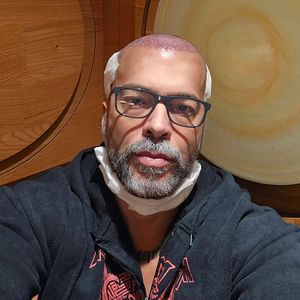Transplantation: Aurelio Savina hat erst jetzt volles Haar