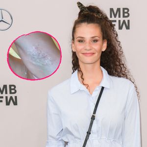 GNTM-Betty Taube lässt sich Botox in die Achseln spritzen