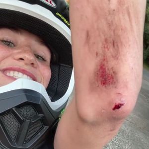 Blutige Wunde: Betty Taube hatte kleinen Motorrad-Unfall