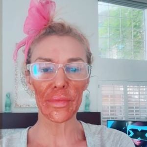 Brandi Glanville erleidet Gesichtsverbrennungen durch Creme