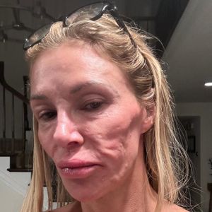 Wegen Gesicht: Brandi Glanville isoliert sich zunehmend