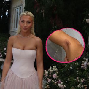 Tammy Hembrow zeigt Hautkrebsnarbe und warnt vor der Sonne