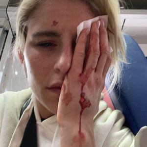 Beim Joggen verletzt: Caro Daur muss blutend ins Krankenhaus
