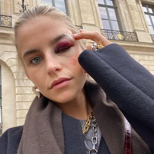 Nach Unfall: Caro Daur mit fettem Veilchen auf Fashion Week