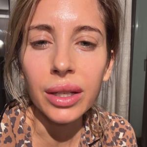 Keine Filler in den Lippen: Cathy Hummels hat dicken Herpes