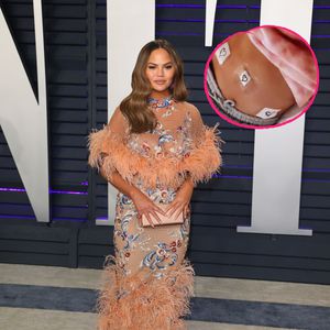 Nach Fehlgeburt: Chrissy Teigen hat eine Endometriose-OP