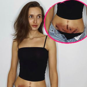 Mutig: Anna Wilken zeigt die Auswirkungen einer Endometriose