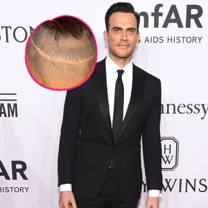 "Glee"-Star lässt sich seit 16 Jahren Haare transplantieren