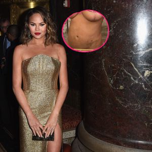 Kurz nach Endometriose-OP: Chrissy Teigen zeigt sich nackt
