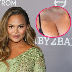 Fruchtbarkeitsbehandlung: Chrissy Teigen zeigt ihre Wunden