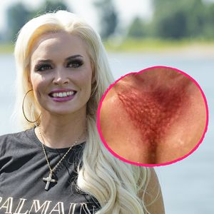 Dicke Pusteln? Daniela Katzenberger schockt mit Dekolleté!