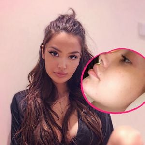 Schonungslose Wahrheit: Ex-GNTM-Enisa hat schmerzhafte Akne