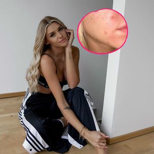 Fotos ohne Filter: Gerda Lewis teilt ehrliches Akne-Update