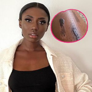 Fiese Verbrennungen: GNTM-Jasmin ärgert sich über Laser-Fail