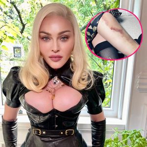 Die Fans sind in Sorge: Madonna zeigt XXL-Bluterguss am Bein