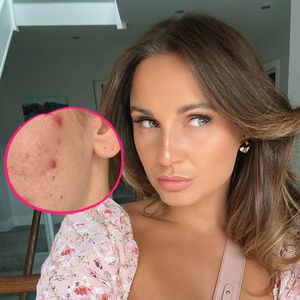 UK-Star Sam Faiers "oben ohne": Schlimme Akne durchs Stillen