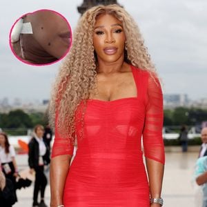 Serena Williams wurde wegen einer Zyste am Hals operiert