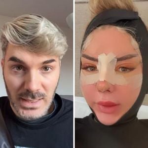 Sam Dylan warnt Fans vor Emma Fernlunds Beauty-Eingriffen