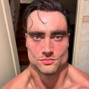 Influencer Connor Murphy (†32) injizierte wohl Flüssiggold