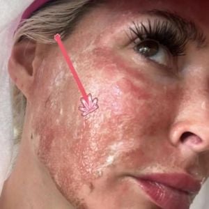 Beauty-Eingriff: Daniela Katzenberger lässt Gesicht lasern