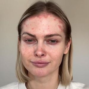 Darya Strelnikova will ihre Schuppenflechte nicht verstecken