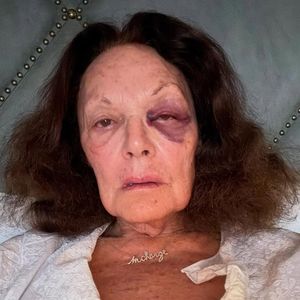 Aua: Diane von Furstenberg zeigt ihr blaues Auge nach Sturz
