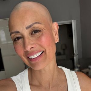 Kreisrunder Haarausfall: Melanie Sykes zeigt sich mit Glatze