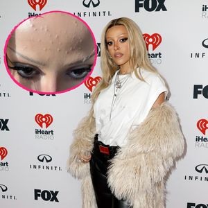 Nach Red Carpet: Doja Cat schämt sich nicht für unreine Haut