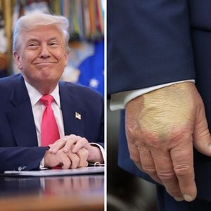 Donald Trumps Hand ist "vom vielen Händeschütteln" verfärbt