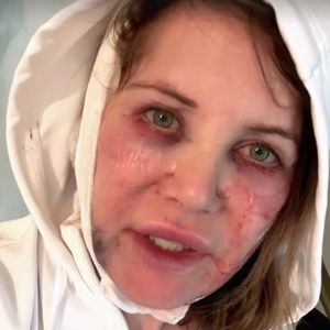 Grün und blau: Doreen Dietel nimmt Unterlidstraffung vor!
