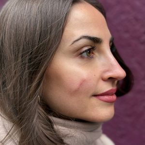 Ekat Leonova gibt ein Update zu ihrem entfernten Muttermal