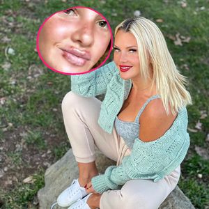 "Pechvogel": Evelyn Burdecki hat vier Lippen-Herpesbläschen