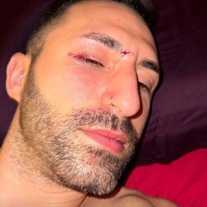 Wegen Albtraum: Fabio De Pasquale verlor fast sein Auge