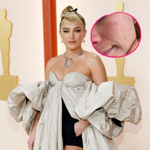 Florence Pugh witzelt über ihren Pickel vor den Oscars 2023