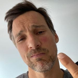 Aua! Florian David Fitz zeigt fiesen Wespenstich im Gesicht