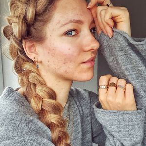 Wegen Pickel-Hate? Ex-GNTM-Hanna startet Anti-Mobbing-Aufruf