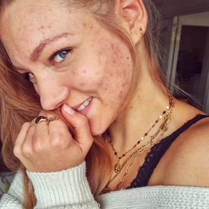 Pille abgesetzt: Ex-GNTM-Hanna kämpft immer noch gegen Akne!