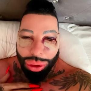 Völlig geschwollen: Harald Glööckler unterzog sich Beauty-OP