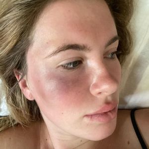Heftige Fotos: Ireland Baldwin wurde überfallen und verletzt