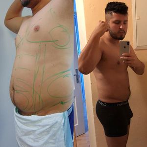 DSDS-Star Isa Martíno: Er ließ sich 3,4 Liter Fett absaugen!