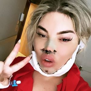 Beauty-Filler ausgelaufen: Jessica Alves zeigt Loch im Kinn