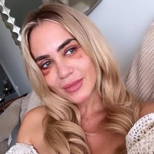 Fettgnubbel hinterm Auge: Jessica Haller verrät neue Details