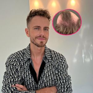 Schlimmer Haarausfall: So sah Julian Claßen vor der OP aus