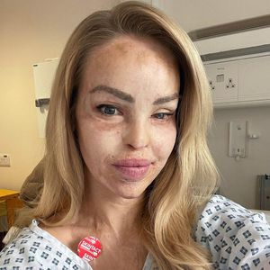 Not-OP an Speiseröhre: Säure-Opfer Katie Piper gibt Update