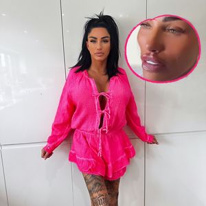 Nach Face-Lift: Katie Price lässt sich Lippen aufspritzen